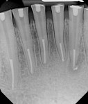 Figure 17  A final radiograph shows the completed cases with prepared post spaces with the proposed drill-less technique. The matching posts were mailed to the referring prosthodontist for use.