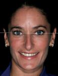 Figure 3  Horizontal perspective guided by interpupillary line.