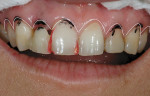 Figure 4  Irregular gingival zeniths were evaluated to correct the canted maxilla.