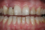 Figure 9  Closer view of the irregular height of the gingival zeniths.