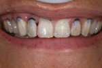 Figure 10  Addition of flowable composite for the final tooth position.