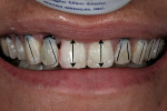 Figure 11  The angulation of the teeth was verified.