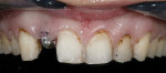 Figure 12  The first arch formed was established with gross reduction, followed by recontouring of gingival architecture and removal of decay.