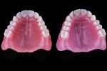 Fig 2. Printed (left) and milled (right) dentures display similar levels of esthetics.