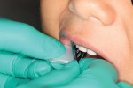 A PSP plate being placed in the mouth for a bitewing radiograph. Note how it can be flexed to increase patient comfort.