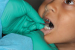 The PSP plate being placed in the patient’s mouth.