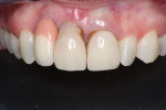 Pretreatment retracted maxillary view, showing the unmatched pink porcelain, failing
composite patch, and exposed margins.