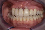 Retracted view of the provisional bridge and veneer showing the defect that remained
after the second tissue graft had been allowed to heal for 8 weeks.