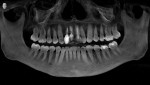 Pretreatment panoramic radiograph. Note the
level of the bone in the area of teeth Nos. 7 and 8.
