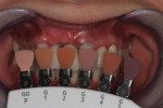 The gingiva shade guide used to communicate with the ceramist.