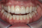Posttreatment retracted smile view, showing
the final restorations with matching pink porcelain.