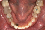 Figure 2  The rehabilitation of the maxillary arch provided an ideal opposing arch for the treatment of the mandibular arch.