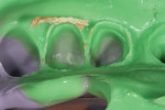 Figure 8  As long as the cord is beneath the margin and a portion of the tooth beneath the margin, the impression will not be compromised.