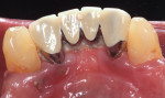 Fig 1. Gingival fenestrations located on the lingual surfaces of Nos. 22 and 23.