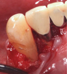 Fig 4. Flap reflection. Note subgingival calculus and loss of lingual plate.