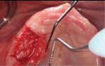 Fig 5. Harvesting of SCTG from edentulous maxillary right alveolar ridge and palate.