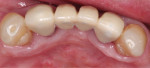 Fig 13. At 2-year follow-up, resolution of gingival fenestrations was evident (Fig 11), probing depth on the direct lingual gingiva of tooth No. 22 was 3 mm (Fig 12), and increased thickness of mandibular anterior lingual gingiva was apparent with no relapse noted (Fig 13).