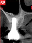 Fig 6. Typical clinical and radiological examination followed by a small-field CBCT. The patient had no pain or discomfort. Small-field CBCT showed loss of buccal plate with the lingual plate intact.