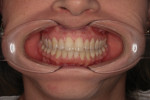 Fig 5. Pretreatment intraoral photographs.