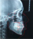 Fig 18. Post-treatment lateral cephalometric radiograph and tracing.