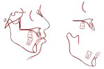 Fig 19. Pretreatment (black tracing) and post-treatment (red tracing) superimpositions.