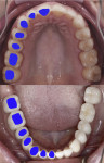 Fig 1. The cross-sections of various teeth, as identified by the blue markings, demonstrate the different shapes of soft-tissue profile needed at the implant platform to replicate a natural tooth emergence profile.