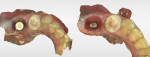 Fig 17. Intraoral scan of a scan body on the implant (left) and after clean-up of the soft tissue in the software (right) demonstrating the emergence profile of a mandibular first molar.