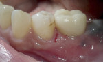 Fig 19. Buccal view demonstrating a natural emergence profile on the implant restoration replacing a first molar.