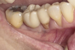 Fig 11. Final implant restoration replicating the emergence profile of the mandibular molar it replaced.