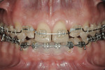 Figure 13  Final orthodontic tooth position. Note anterior open bite.
