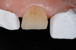 Fig 3. After fabrication of a diagnostic wax-up on an articulator at the estimated VDO
following the principles of phonetics and esthetics, the technique treats one tooth at time or alternating teeth, as shown.
Adjacent teeth were isolated with Teflon tape. Selective etch with phosphoric acid (Select HV® Etch, BISCO), if required, and
bonding agent (All-Bond Universal®, BISCO) were applied and cured.