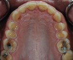 Fig 1. Occlusal and lingual erosive
lesions were present in the maxillary arch. The patient reported being a heavy soda drinker.