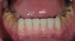 Fig 5. Build-up with flowable composite on teeth Nos. 22
through 27, transferring wax-up to the clinical situation.