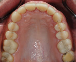 Fig 7. Occlusal view illustrating the ideal transfer of the
proposed wax-up.