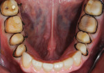 Fig 9. A segmental impression
was done in the mandibular arch. This is less challenging
than trying to do a full-mouth impression with an active
tongue. Note the preservation of marginal peripheral
enamel. Final mandibular anterior veneer preparations and
a final impression would follow (not shown).