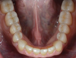 Fig 11. Final mandibular
veneers bonded
in place using
selective etching,
universal bond, and
light-cured resin
cement (eCEMENT®
light-cured, BISCO).