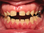 BEFORE. Center bite photograph. The patient presented with amelogenesis imperfecta and a severe anterior
open bite, mandibular midline discrepancy to the left associated with a buccal crossbite, and generalized spacing.