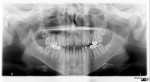 Fig 1.
Panoramic radiograph revealed the hypomaturation and hypocalcification of the enamel. Stainless steel crowns existed on all
four first molars and composite restorations on some mandibular incisors.