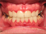 Fig 9. Restorative result. Twelve anterior crowns were placed to improve occlusion and esthetics.