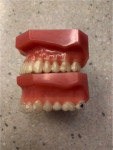 Fig 5. The trimline
on the ClearCorrect aligner (top) is higher on the gingiva than conventional aligners that use a scalloped trimline near the
cementoenamel junction (bottom). This characteristic helps make the ClearCorrect aligner highly retentive.