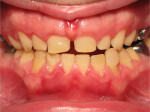 Fig 7. Progress photographs at 6 months (Fig 6) and 9 months (Fig 7) in aligner treatment showed the closing of
the anterior open bite and reduction of the midline discrepancy in conjunction with the buccal crossbite correction. Fig 8.
Final orthodontic position. After 12 months, the occlusal treatment objectives had been reached before restorative treatment.
Fig 9. Restorative result. Twelve anterior crowns were placed to improve occlusion and esthetics.