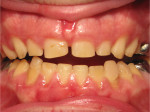 Fig 8.
Final orthodontic position. After 12 months, the occlusal treatment objectives had been reached before restorative treatment.