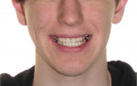 Fig 11. Pre- and
post-treatment smile comparison. The treatment achieved a significant occlusal change and smile makeover. Additionally, the
patient’s profile appearance (not shown) was improved from the use of the aligners, decreasing the vertical jaw relationship
and contributing to the autorotation of the mandible, thus eliminating the need for orthognathic surgery. (Restorative dentistry:
Gregory E. Morgan, DDS, Fresno, California) Before doing additional restorative work, refinement aligners can be used to
address the maxillary diastema due to the incisive frenum attachment, and posterior occlusal preparation can be performed
before completion of the full-mouth rehabilitation.