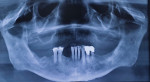Fig 1. Pretreatment panoramic radiograph. Note pneumatized
maxillary sinuses and failing mandibular teeth.