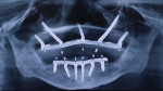 Fig 7. Final radiograph after treatment. The maxilla was restored with Tuff, zygomatic, and Pteryfit implants, while the mandible
was restored with Tuff implants.