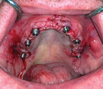 Fig 6. Maxilla sutured after surgery using the author’s
Texas 2-Step™ suture protocol.