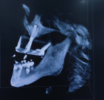 Fig 9. CBCT scan (lateral view) of restored case.