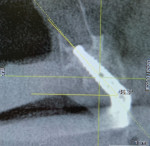 Fig 10. CBCT scan of Pteryfit implant engaging the
pterygomaxillary complex.