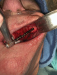 Fig 3. Extra-sinus
drilling technique for placement of zygomatic implants.