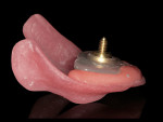 Figure 12  Maxillary and mandibular record bases with central bearing device mounted using light-activated laboratory resin.
